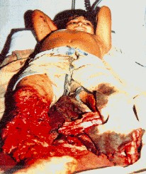 Alexander Arias Pinto, mutilado por mina del ELN